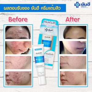 Yanhee-acne-cream