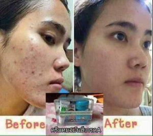 Dr. Yanhee Creams Set melasma | Worldwide Shipping | Retail