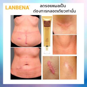 Lan Be Na TCM Scar And Acne Mark Removal Gel Ointment