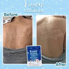 Frozen Collagen