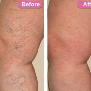 PhiloSoft LegActif Cream 25g for varicose veins and stretch marks