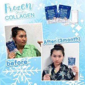 Frozen Collagen
