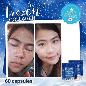 Frozen Collagen