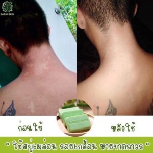 Melon Acne Soap