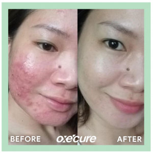 Oxe Cure Sulfur Soap