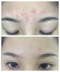 Oxe Cure Sulfur Soap