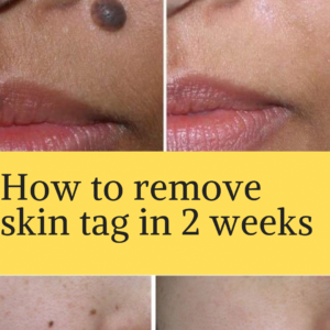 Mole Erase 3ml Mole and Freckle Care Solution