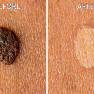 Mole Erase 3ml Mole and Freckle Care Solution