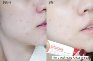 Puricas Dragon’s Blood Scar Gel