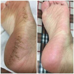 Mrs. Foot Spa Heel Scrub